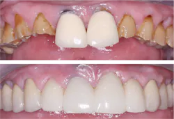 dental restorations