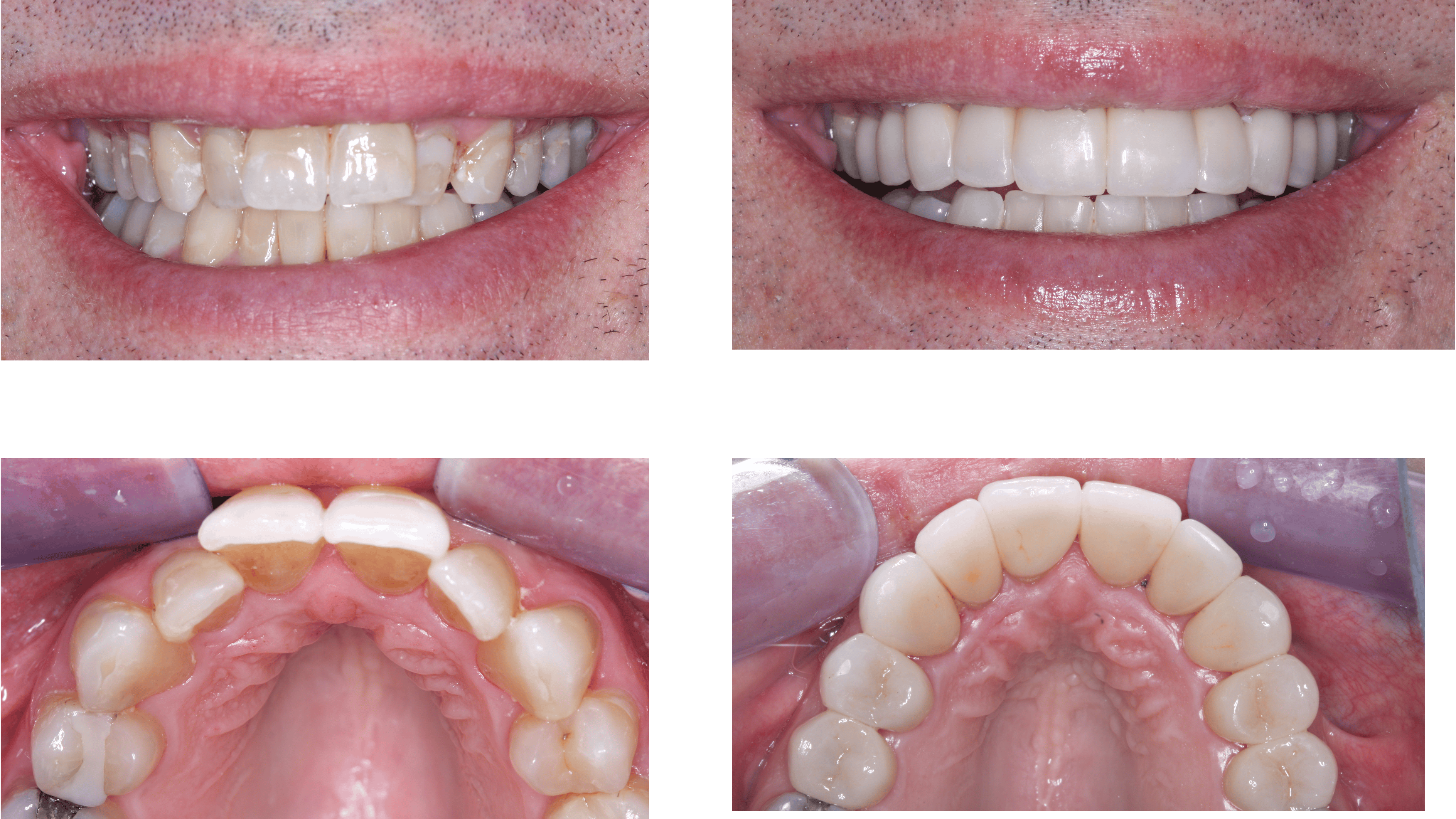 anterior crowns
