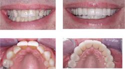 anterior crowns