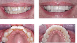 anterior crowns