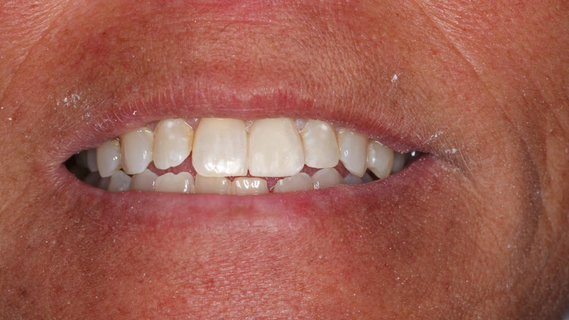 universal composite
