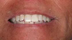 universal composite