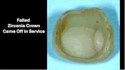 Figure 1: Resin cemented study crown that came off at six months of service. Note leakage on margins and up axial walls and lack of bond of filler material in this short time.