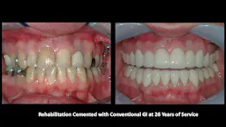 Figure 2: Porcelain-fused-to-metal restorations cemented with conventional glass ionomer cements at 26 years of service.