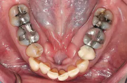Figure <span SEQ Figure * ARABIC 1: Pre-op: Full-mouth failing dentistry: amalgam overhangs, secondary decay, and visible crack lines throughout. Intraoperative: irritated, bleeding tissue after removal of failing restorations—the moment most cases slow down or get temporized.