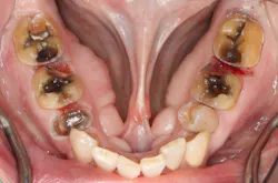 Figure 2: Post-laser tissue management: Caries removed, clean field, hemostasis achieved, margins accessible. Buildups placed, preps finalized, ready to scan.