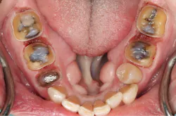 Figure 3: Post-laser tissue management: Teeth rebuilt from gum tissue, clean field, hemostasis achieved, margins accessible. Buildups placed, preps finalized, ready to scan.