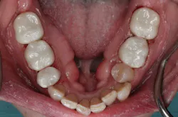 Figure <span style='font-size:10.0pt;font-family:'Arial',sans-serif;color:windowtext; <span SEQ Figure * ARABIC <span style='mso-element: 4: Same-day final restorations: Permanent crowns delivered in a single sedation visit. No temporaries, no return appointment.