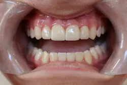 Teeth #7–10 restored with crowns fabricated and perfected using Digital Design Preview and Polychromatic Shade technology. Translucency, chroma, texture, and the natural transition from incisal edge to gingival margin were digitally engineered to match the surrounding dentition, providing master-ceramist results, without the added time and expense. —Clinical dentistry and photography courtesy of Dr. Chrislyn Fite of Bowling Green, Kentucky