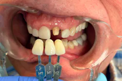 Teeth #7–10 restored with crowns fabricated and perfected using Digital Design Preview and Polychromatic Shade technology. Translucency, chroma, texture, and the natural transition from incisal edge to gingival margin were digitally engineered to match the surrounding dentition, providing master-ceramist results, without the added time and expense. —Clinical dentistry and photography courtesy of Dr. Chrislyn Fite of Bowling Green, Kentucky