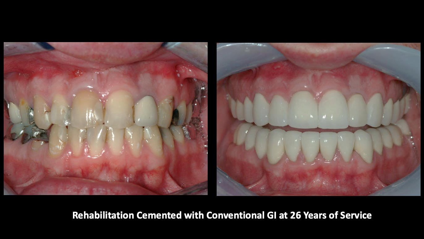 reemergence of glass ionomer