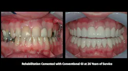 reemergence of glass ionomer