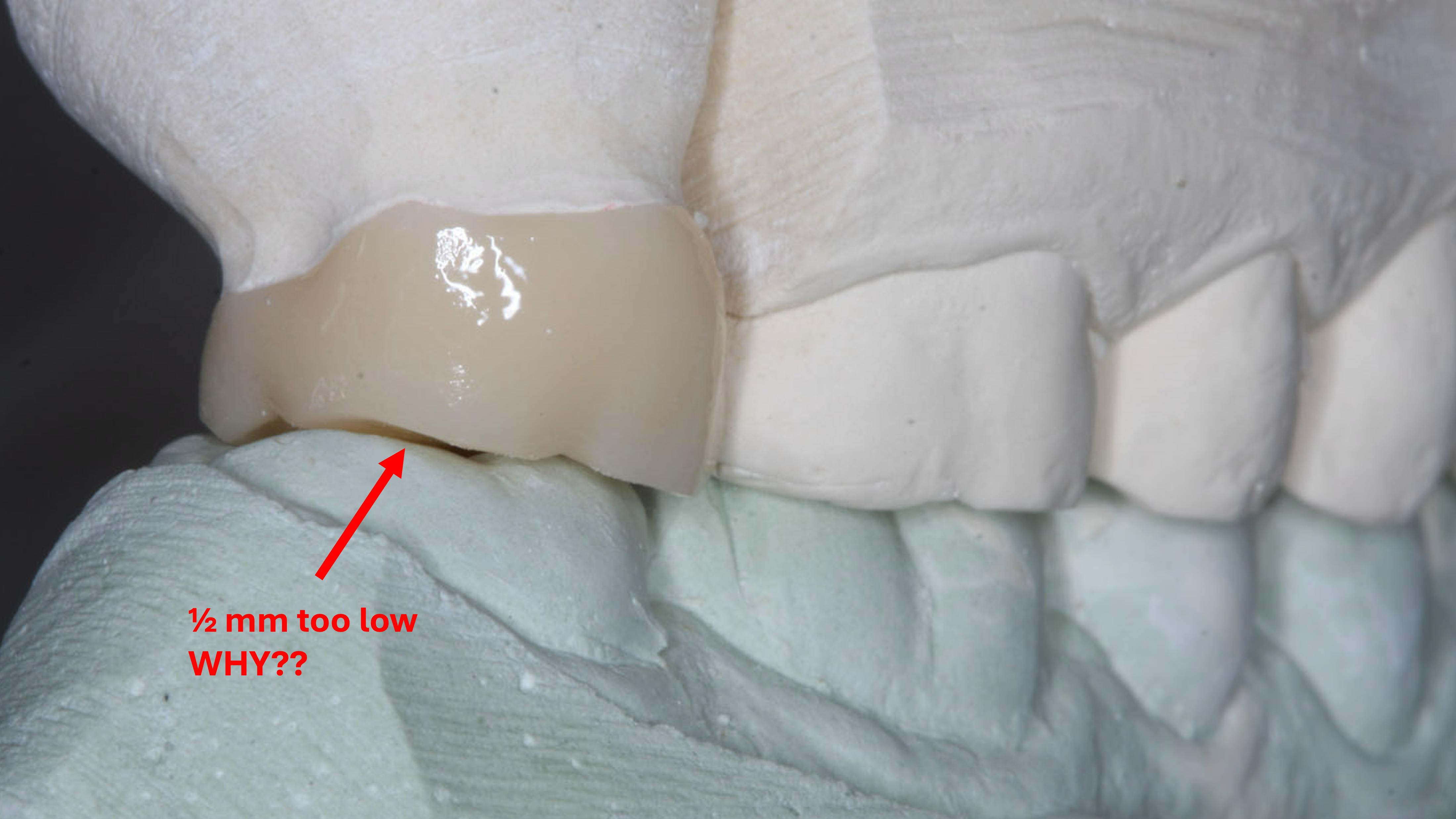 Figure 1: Most laboratories are spacing zirconia crowns up to 500 microns too low and out of occlusion. This disrupts occlusion until tooth extrusion happens on both the new crown and the opposing crown tooth. Tell your lab technician to reduce that amount significantly to as low as 25 microns.