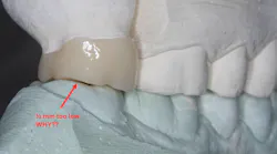 Figure 1: Most laboratories are spacing zirconia crowns up to 500 microns too low and out of occlusion. This disrupts occlusion until tooth extrusion happens on both the new crown and the opposing crown tooth. Tell your lab technician to reduce that amount significantly to as low as 25 microns.
