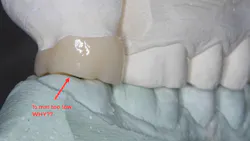 Figure 1: Most laboratories are spacing zirconia crowns up to 500 microns too low and out of occlusion. This disrupts occlusion until tooth extrusion happens on both the new crown and the opposing crown tooth. Tell your lab technician to reduce that amount significantly to as low as 25 microns.