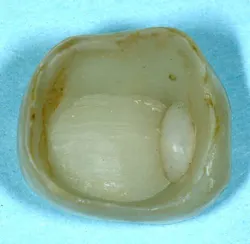 Figure 2: Debonded resin cemented crown at six months of service. Note leakage and lack of bond of filler material. This photo shows obvious stain on margins and internally on this zirconia study crown that had been in the mouth for only a short time before coming off.