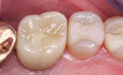 Figure 3: Zirconia crown with loose contact areas