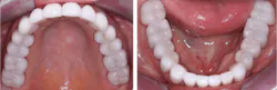 Figure 4: Recent zirconia rehabilitation with no external coloration. Crowns were stained at the presintered stage and polished only. (Prosthodontist Gordon Christensen, Lab Tech Jed Archibald)