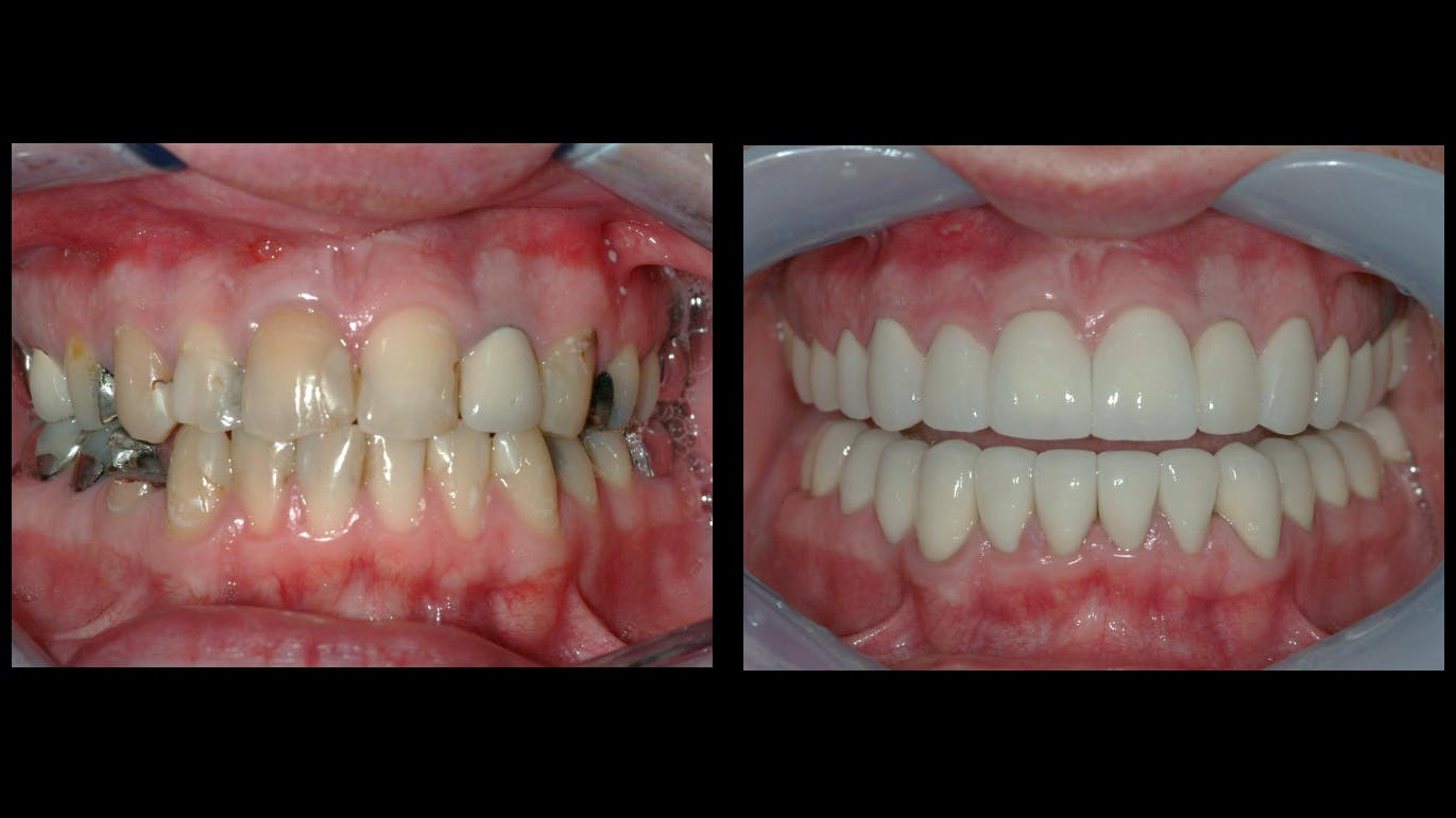 the need for reemergence of glass ionomer