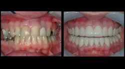 the need for reemergence of glass ionomer
