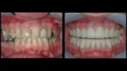the need for reemergence of glass ionomer