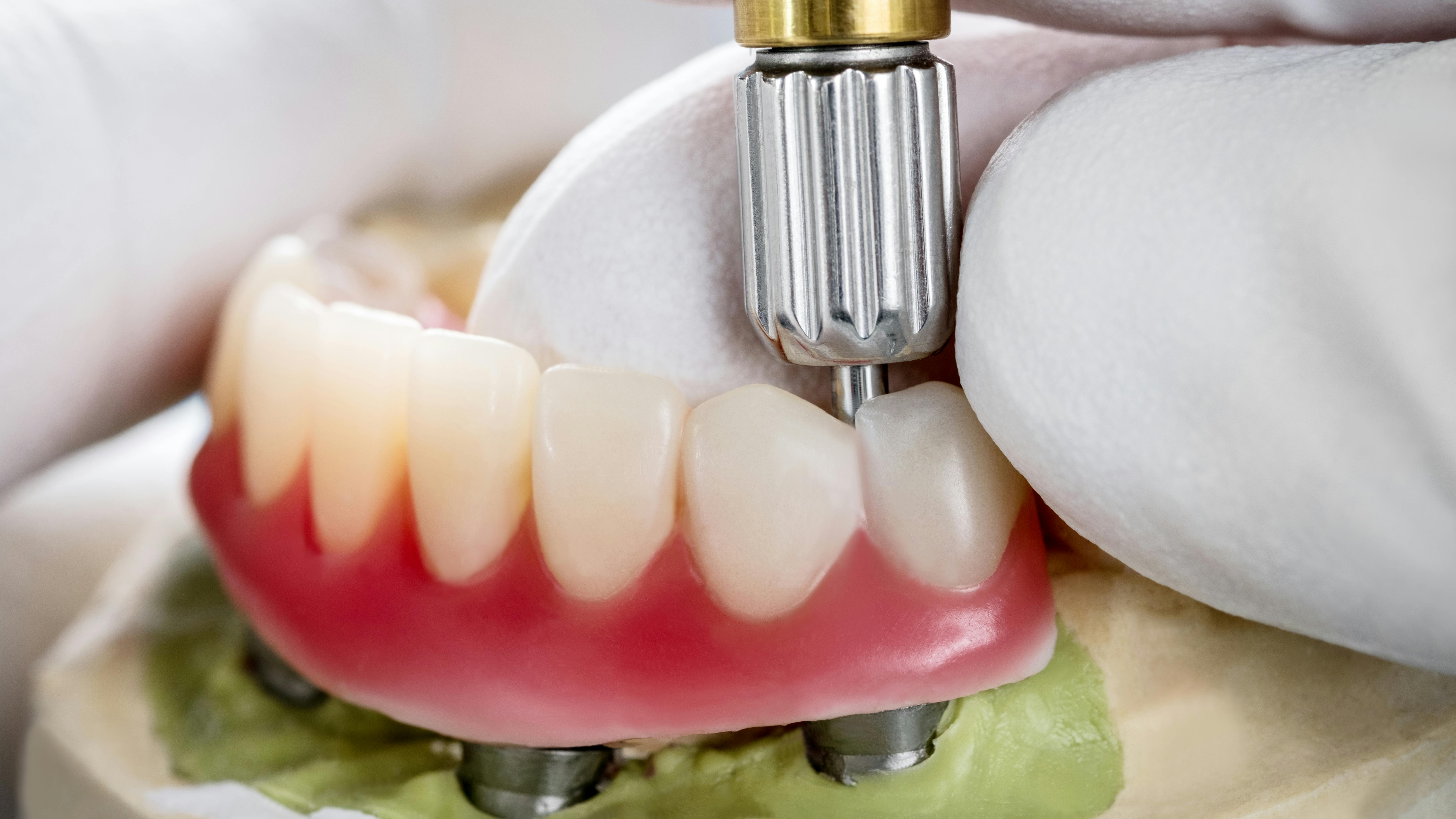 preventing peri-implant disease